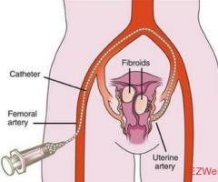 USA Fibroid Centers in Richardson, TX